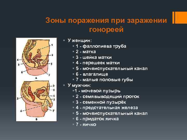 Зоны поражения при заражении гонореей § У женщин: § 1 - фаллопиева труба §