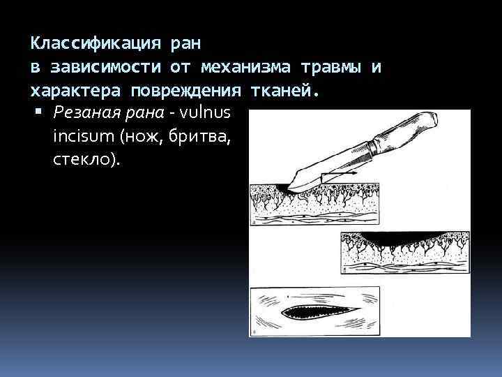 Резано колотые. Классификация колото-резаных РАН. Резаная рана характеристика. Характеристика резаных РАН. Механизм повреждения резаной раны.