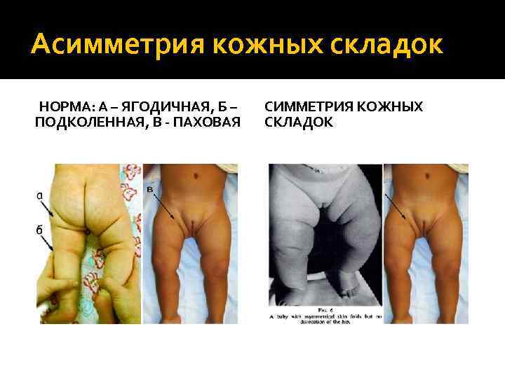 Асимметрия кожных складок НОРМА: А – ЯГОДИЧНАЯ, Б – ПОДКОЛЕННАЯ, В - ПАХОВАЯ СИММЕТРИЯ