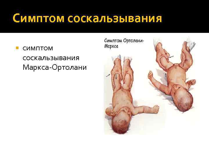 Симптом соскальзывания симптом соскальзывания Маркса-Ортолани 