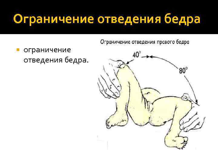 Ограничение отведения бедра ограничение отведения бедра. 