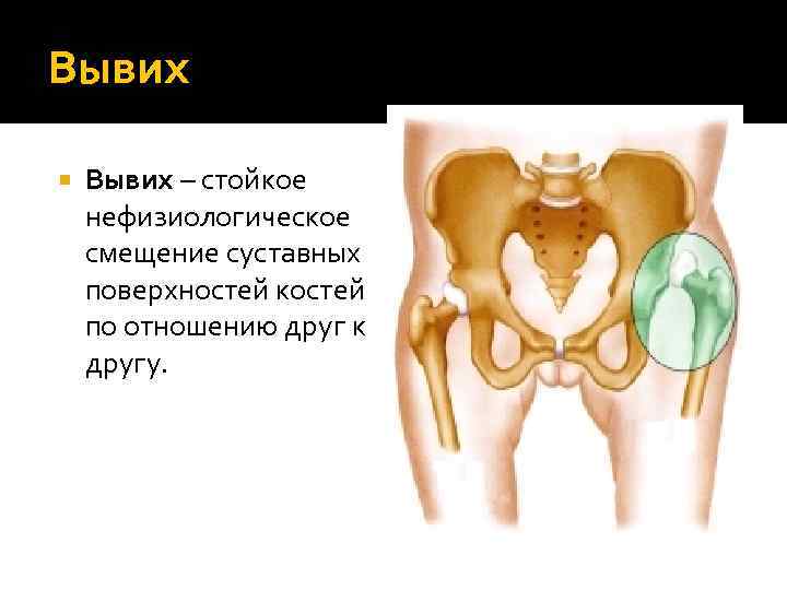 Вывих – стойкое нефизиологическое смещение суставных поверхностей костей по отношению друг к другу. 