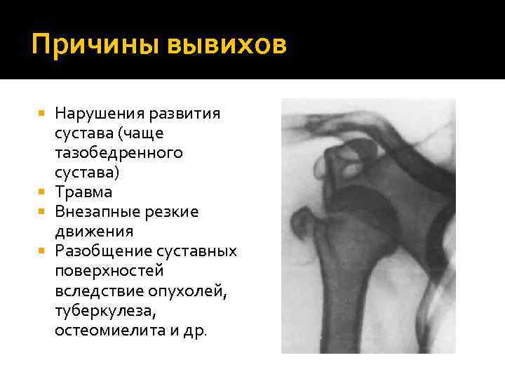 Причины вывихов Нарушения развития сустава (чаще тазобедренного сустава) Травма Внезапные резкие движения Разобщение суставных