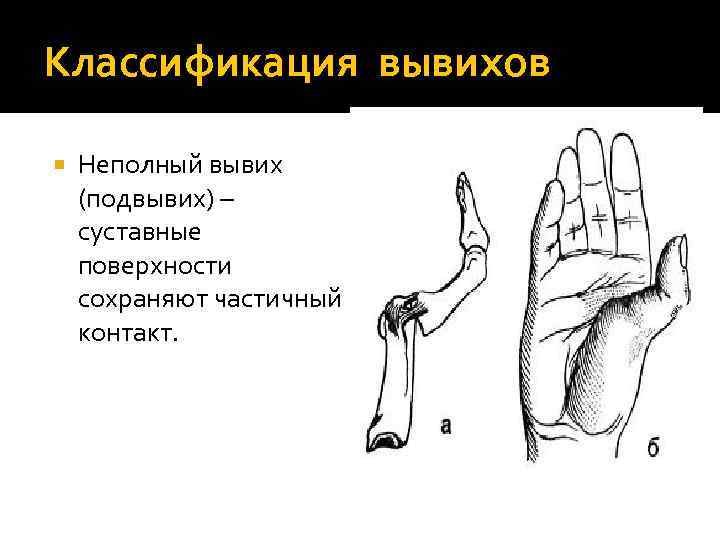 Классификация вывихов Неполный вывих (подвывих) – суставные поверхности сохраняют частичный контакт. 