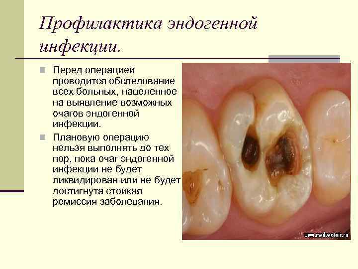 Профилактика эндогенной инфекции. n Перед операцией проводится обследование всех больных, нацеленное на выявление возможных