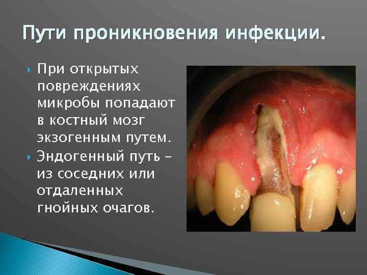 Пути проникновения инфекции. При открытых повреждениях микробы попадают в костный мозг экзогенным путем. Эндогенный