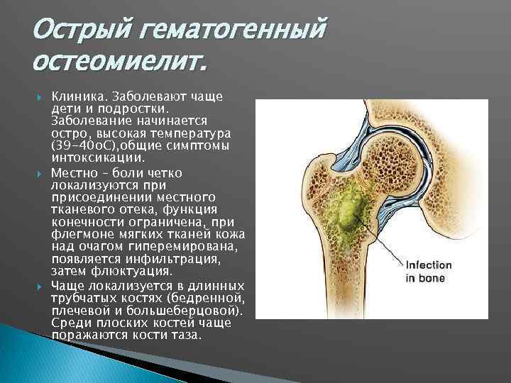 Острый гематогенный остеомиелит. Клиника. Заболевают чаще дети и подростки. Заболевание начинается остро, высокая температура