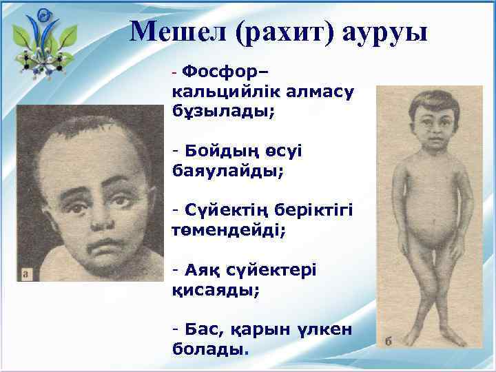 Мешел (рахит) ауруы Фосфор– кальцийлік алмасу бұзылады; - - Бойдың өсуі баяулайды; - Сүйектің