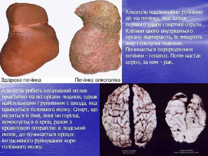 Алкоголь надзвичайно руйнівно діє на печінку, яка зазнає першого удару спиртної отрути. Клітини цього