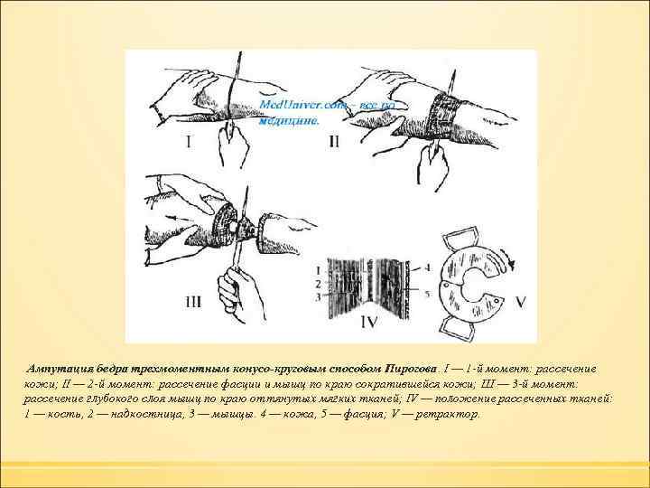 Ампутации топографическая анатомия