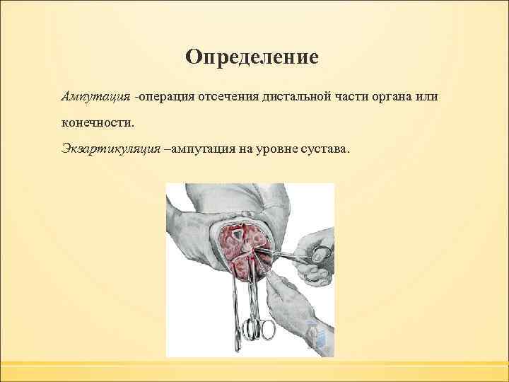  Определение Ампутация -операция отсечения дистальной части органа или конечности. Экзартикуляция –ампутация на уровне