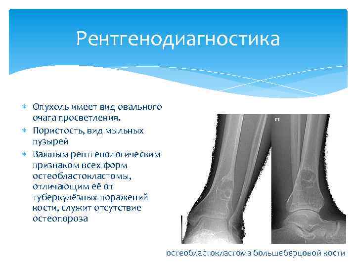 Рентгенодиагностика Опухоль имеет вид овального очага просветления. Пористость, вид мыльных пузырей Важным рентгенологическим признаком