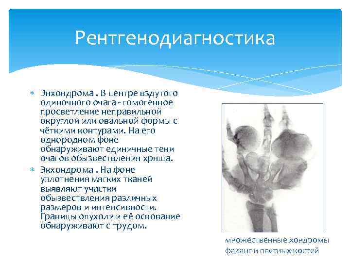 Рентгенодиагностика Энхондрома. В центре вздутого одиночного очага - гомогенное просветление неправильной округлой или овальной