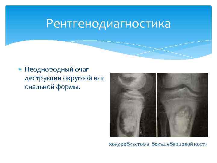 Рентгенодиагностика Неоднородный очаг деструкции округлой или овальной формы. хондробластома большеберцовой кости 