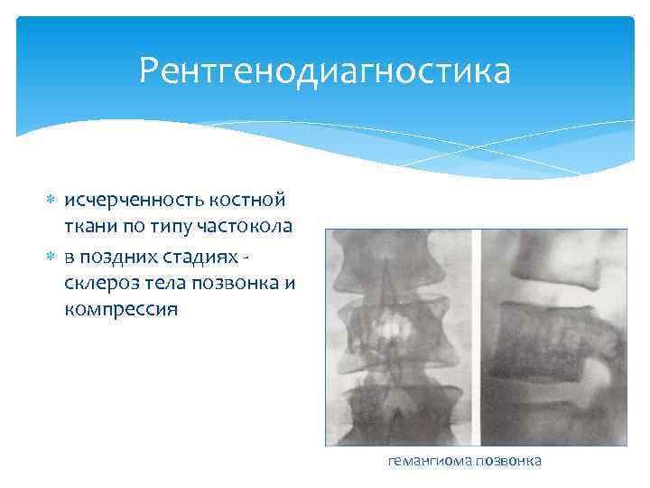 Рентгенодиагностика исчерченность костной ткани по типу частокола в поздних стадиях склероз тела позвонка и