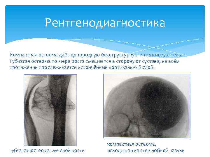 Рентгенодиагностика Компактная остеома даёт однородную бесструктурную интенсивную тень. Губчатая остеома по мере роста смещается