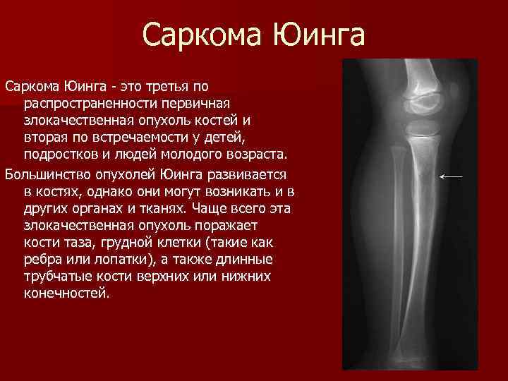 Рак кости ноги. Остеогенная саркома ноги. Остеогенная остеопластическая саркома. Саркома Юинга плечевой кости кт. Саркома Юинга мягких тканей голени.