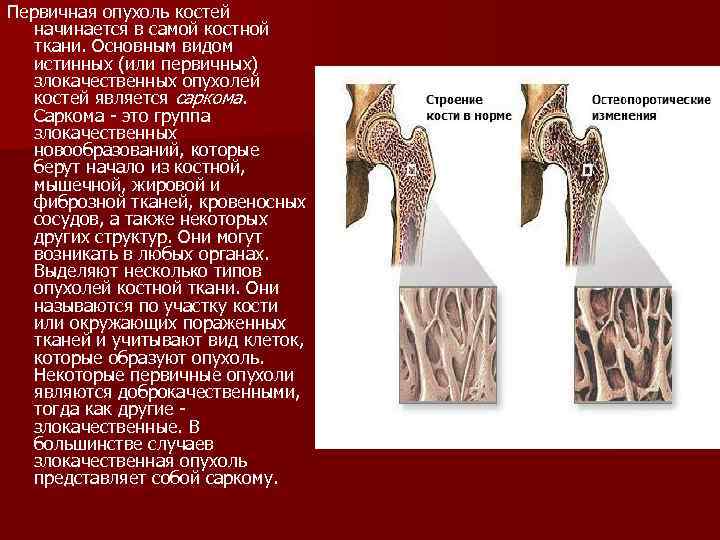 Опухоли костей презентация