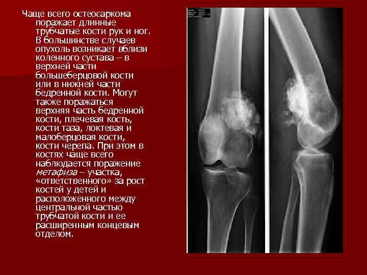 Злокачественные опухоли костей презентация