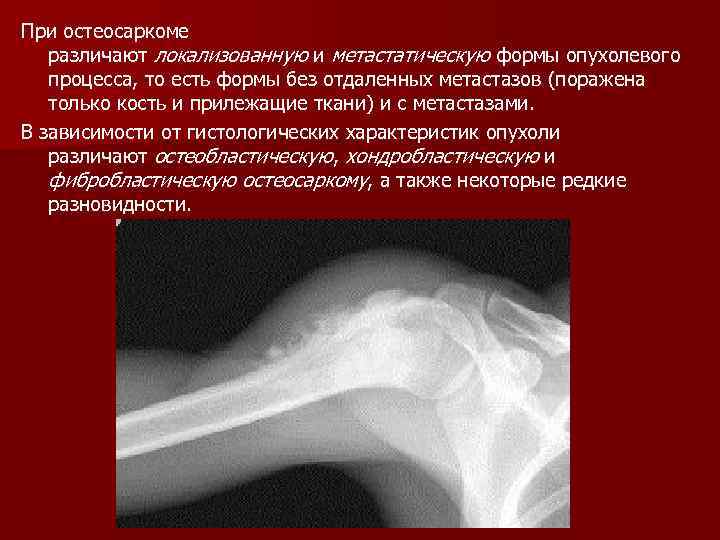 При остеосаркоме различают локализованную и метастатическую формы опухолевого процесса, то есть формы без отдаленных