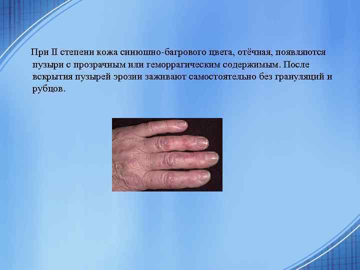  При II степени кожа синюшно-багрового цвета, отёчная, появляются пузыри с прозрачным или геморрагическим