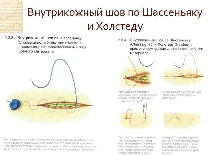 Внутрикожный шов по Шассеньяку и Холстеду 