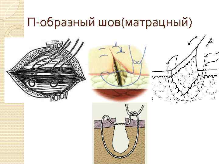 П-образный шов(матрацный) 