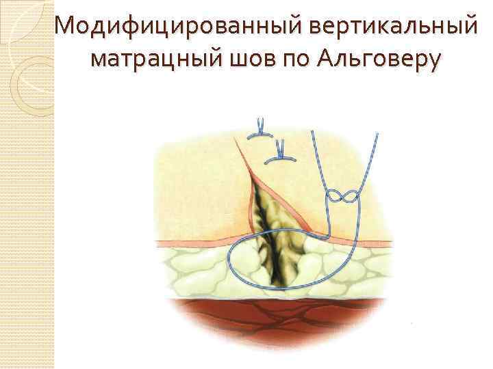 Модифицированный вертикальный матрацный шов по Альговеру 