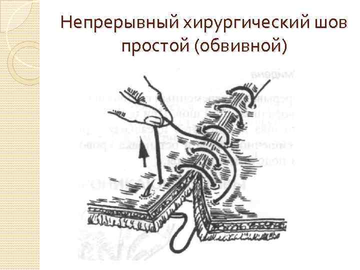 Непрерывный хирургический шов простой (обвивной) 