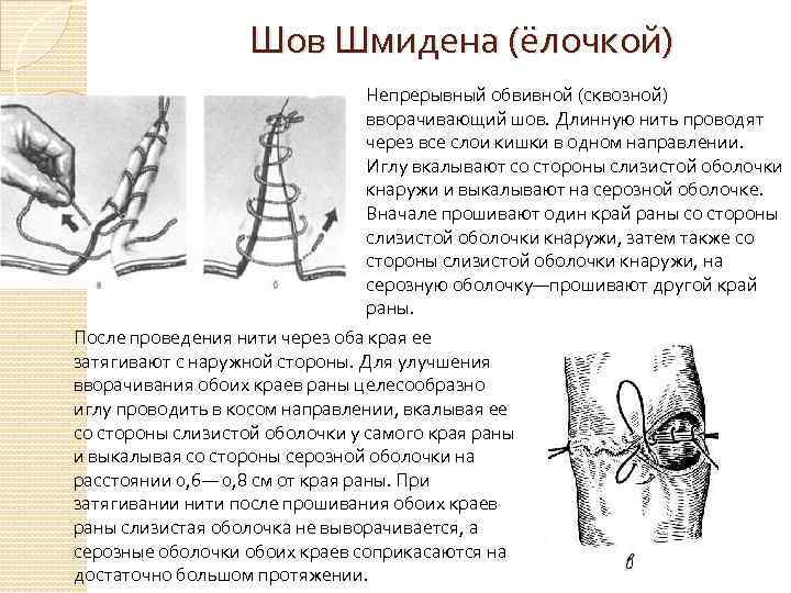 Шов Шмидена (ёлочкой) Непрерывный обвивной (сквозной) вворачивающий шов. Длинную нить проводят через все слои
