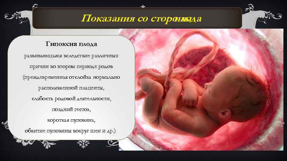  Показания со стороны плода Гипоксия плода развивающаяся вследствие различных причин во втором периоде