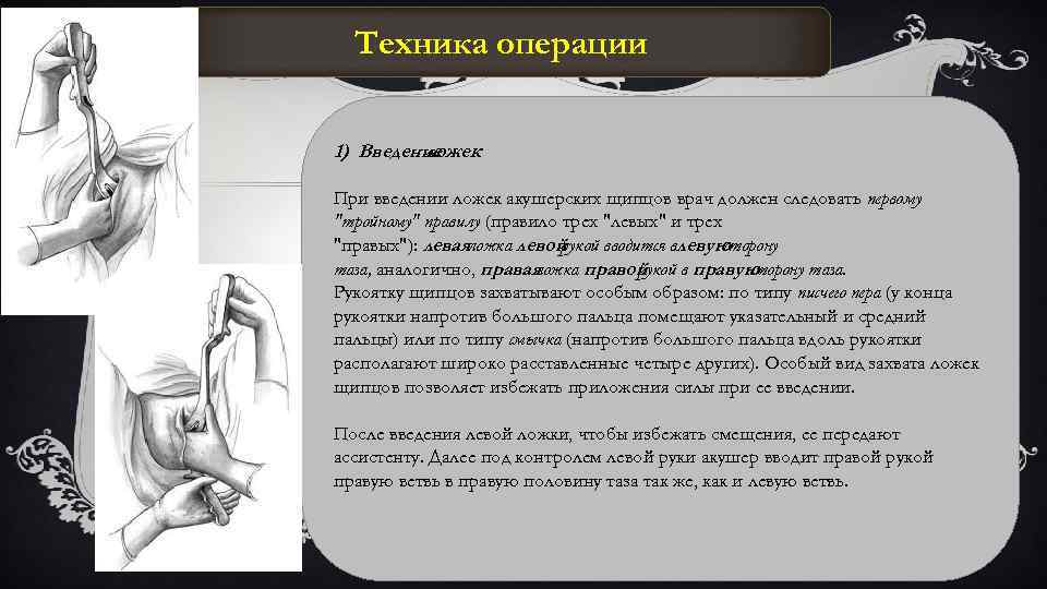 Техника операции 1) Введение ложек При введении ложек акушерских щипцов врач должен следовать первому