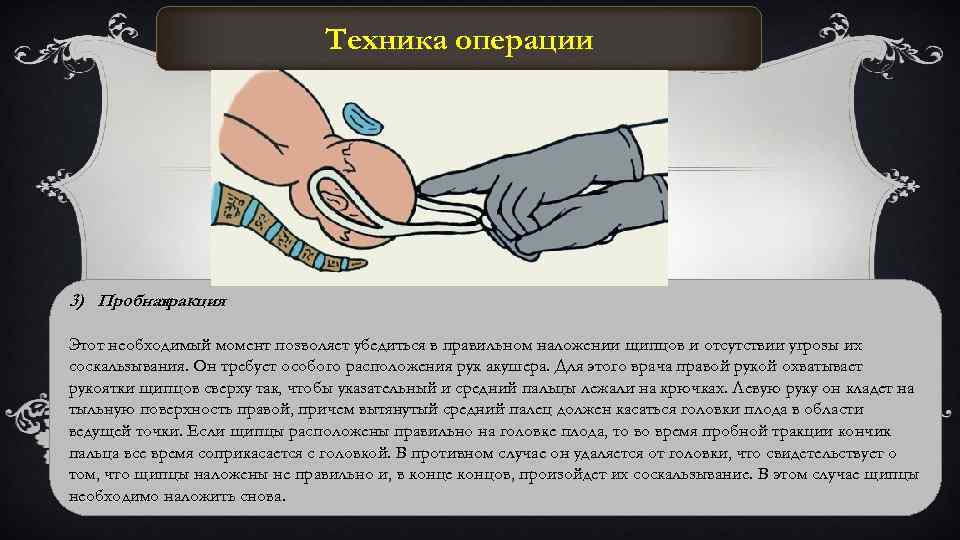 Техника операции 3) Пробная тракция Этот необходимый момент позволяет убедиться в правильном наложении щипцов