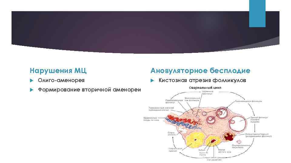 Нарушения МЦ Олиго-аменорея Формирование вторичной аменореи Ановуляторное бесплодие Кистозная атрезия фолликулов 