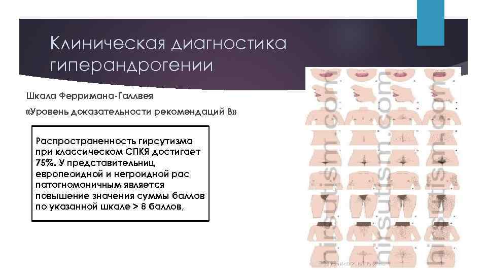 Клиническая диагностика гиперандрогении Шкала Ферримана-Галлвея «Уровень доказательности рекомендаций В» Распространенность гирсутизма при классическом СПКЯ