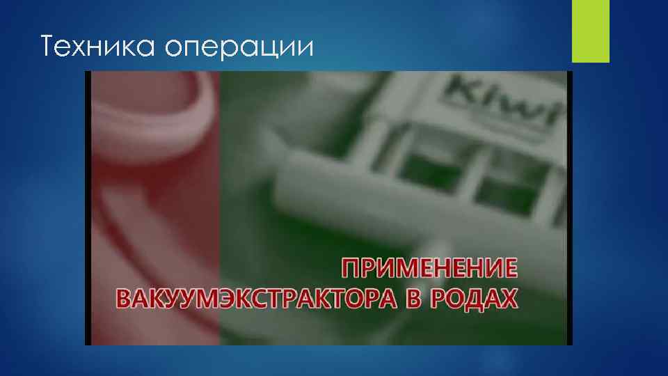 Техника операции 