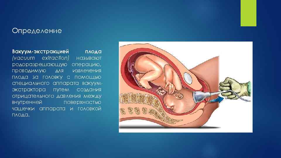 Определение Вакуум-экстракцией плода (vacuum extraction) называют родоразрешающую операцию, проводимую для извлечения плода за головку
