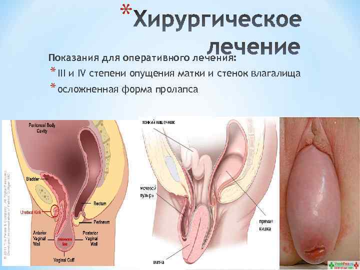 * Показания для оперативного лечения: * III и IV степени опущения матки и стенок