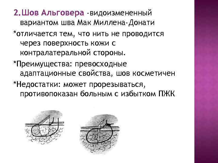 2. Шов Альговера -видоизмененный вариантом шва Мак Миллена-Донати *отличается тем, что нить не проводится