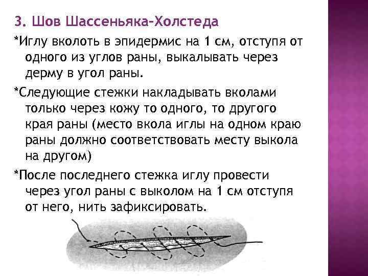 3. Шов Шассеньяка-Холстеда *Иглу вколоть в эпидермис на 1 см, отступя от одного из