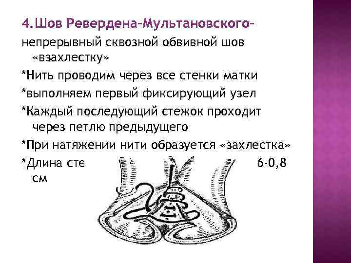 4. Шов Ревердена-Мультановскогонепрерывный сквозной обвивной шов «взахлестку» *Нить проводим через все стенки матки *выполняем