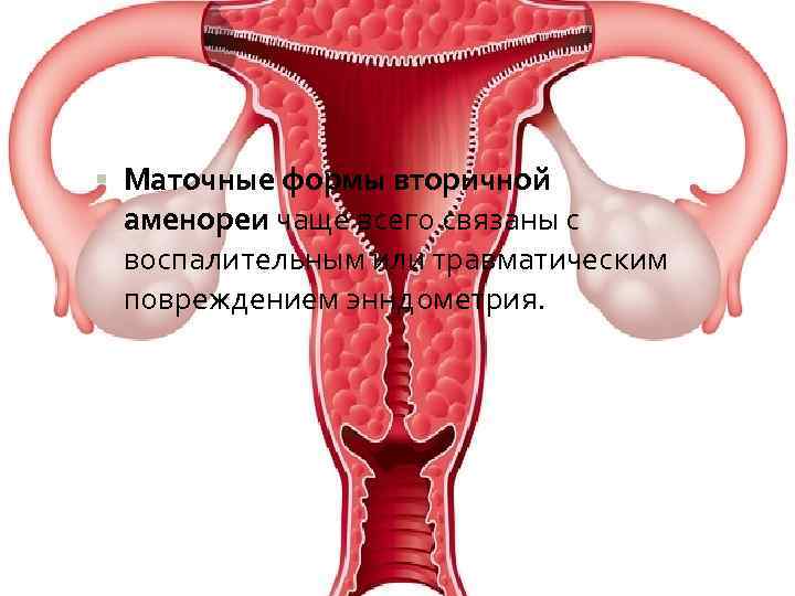  Маточные формы вторичной аменореи чаще всего связаны с воспалительным или травматическим повреждением энндометрия.