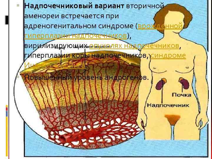  Надпочечниковый вариант вторичной аменореи встречается при адреногенитальном синдроме (врожденной гиперплазии надпочечников), вирилизирующих опухолях