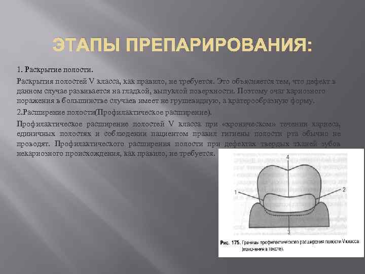 Полость поверхность. Этапы препарирования 1 класса по Блэку. Этапы препарирования кариозных полостей. Препарирование по Блеку 5 классов. Этапы формирования кариозных полостей 3 4 5 классов.