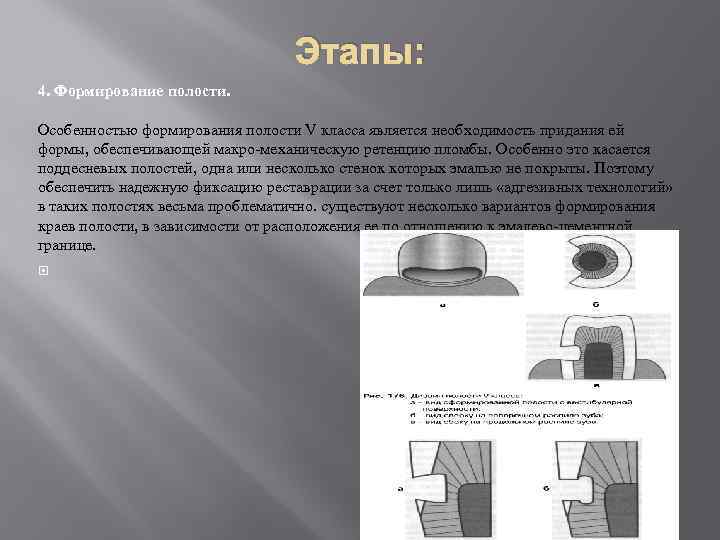 Формирование полости. Препарирование кариозных полостей 5 класса. Методика формирования полостей 5 класса. Препарирование полостей 5 класса по Блэку. Формирование полости по 5 классу.