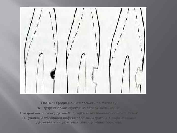 Рис. 4. 1. Традиционная полость по V классу. А – дефект локализуется на поверхности
