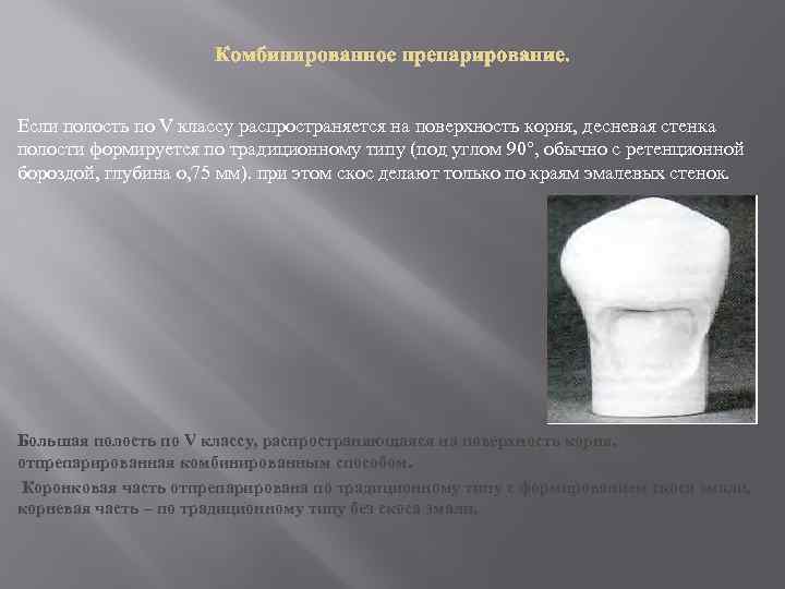 Классы препарирования по блэку. Препарирование по 5 классу. Препарирование полости по 5 классу. Препарирование 5 класса по Блэку. Препарирование полостей 5 класса по Блэку.