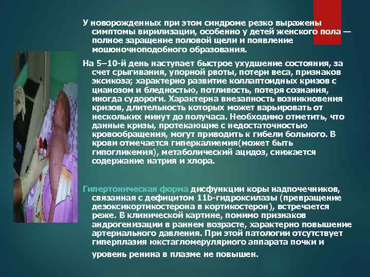 У новорожденных при этом синдроме резко выражены симптомы вирилизации, особенно у детей женского пола