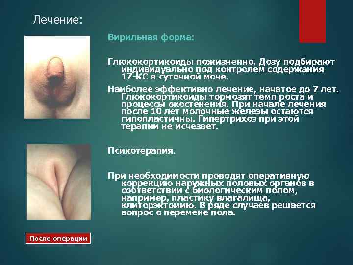 Лечение: Вирильная форма: Глюкокортикоиды пожизненно. Дозу подбирают индивидуально под контролем содержания 17 -КС в