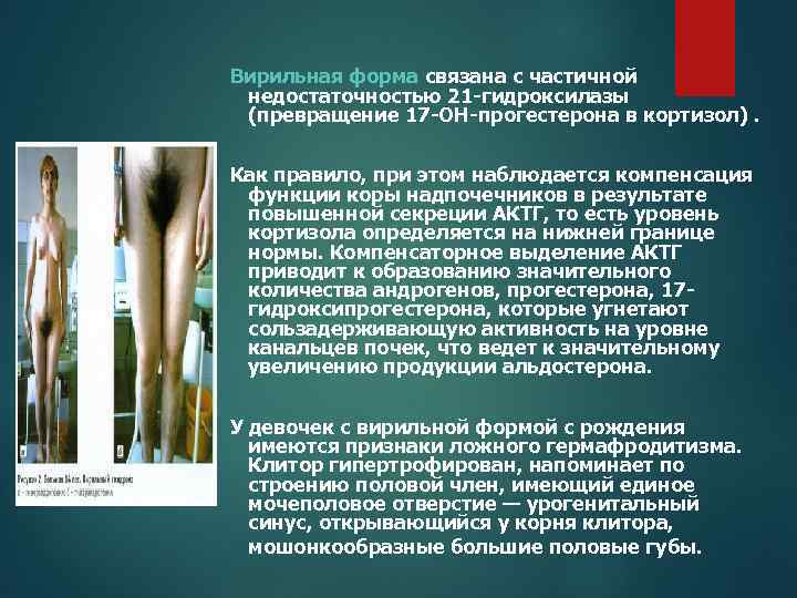 Вирильная форма связана с частичной недостаточностью 21 -гидроксилазы (превращение 17 -ОН-прогестерона в кортизол). Как